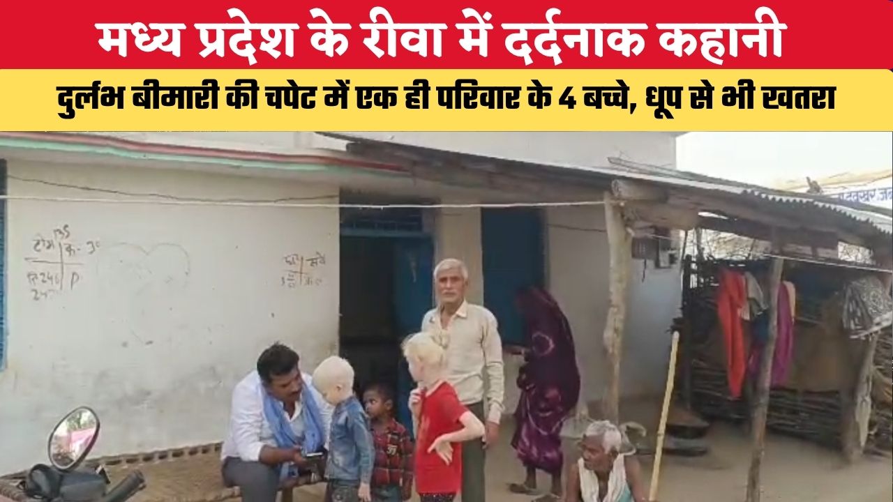 मध्य प्रदेश के रीवा में दर्दनाक कहानी, दुर्लभ बीमारी की चपेट में एक ही परिवार के 4 बच्चे, धूप से भी खतरा