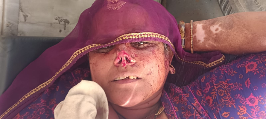 Rajasthan News: दामाद ने कैंची से काटी सास की नाक, कटे हुए हिस्से को लेकर हुआ रफूचक्कर