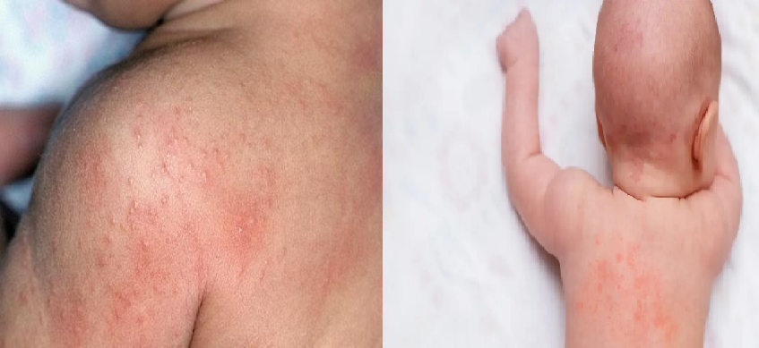 How To Get Rid Of Heat Rash- गर्मियों में जल्द से जल्द कैसे पाएं घमौरियों से छुटकारा, जानें कुछ घरेलू उपाय