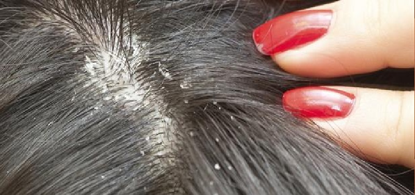 Dandruff Treatments and Remedies: सर्दियों में डैंड्रफ से हैं परेशान तो जरूर अपनाएं ये 5 घरेलू उपाय