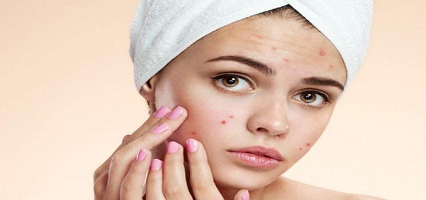 Health Tips: एक दिन में पिम्पल्स को कहे बॉय, बस फॉलो करें ये टिप्स