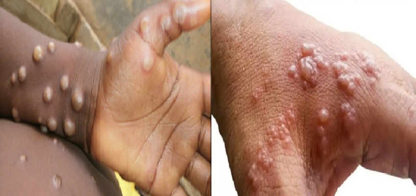 MONKEYPOX: कोरोना के बाद इस वायरस ने ब्रिटेन में मचाई खलबली, इन लोगों को सावधान रहने की जरूरत
