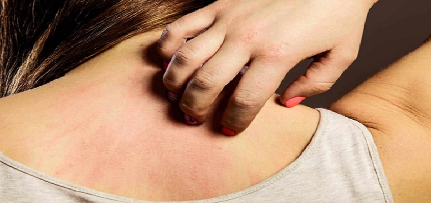 Health tips: क्या आप भी है घमौरियों से परेशान, इन घरेलू नुस्खों का इस्तेमाल कर पाएं छुटकारा