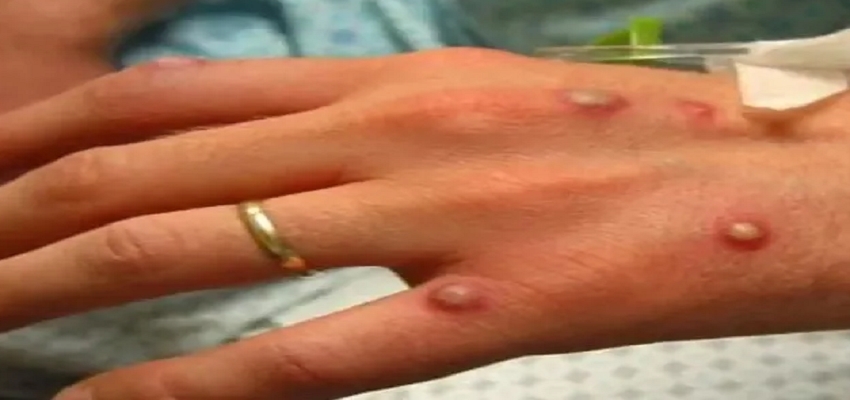 HEALTH TIPS: मंकीपॉक्स को लेकर अलर्ट पर हरियाणा सरकार, जारी की एडवाइजरी