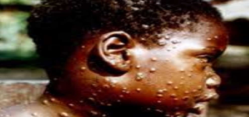 Monkeypox: भारत के इस राज्य में मंकीपॉक्स ने दी दस्तक!