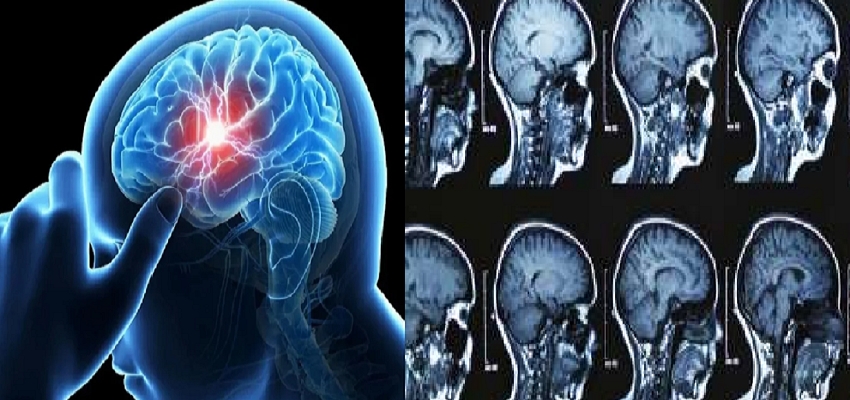 आखिर क्यों मनाया जाता है World Brain Tumor Day, जानें इस दिन का इतिहास और महत्व