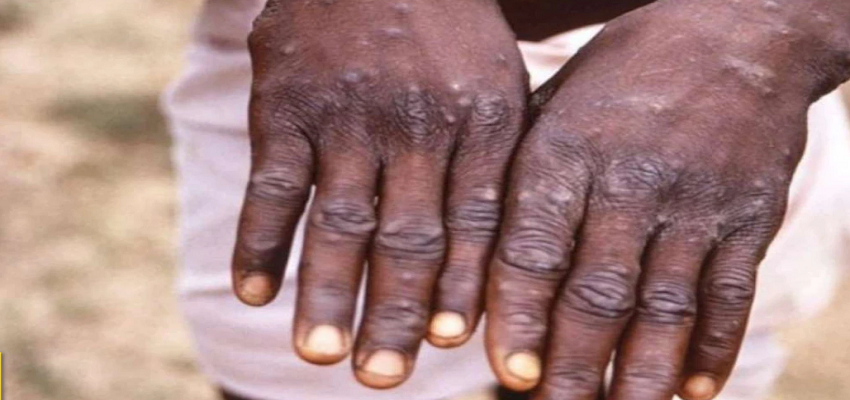 MONKEYPOX: भारत में मंकीपॉक्स का तीसरा मामला आया सामने