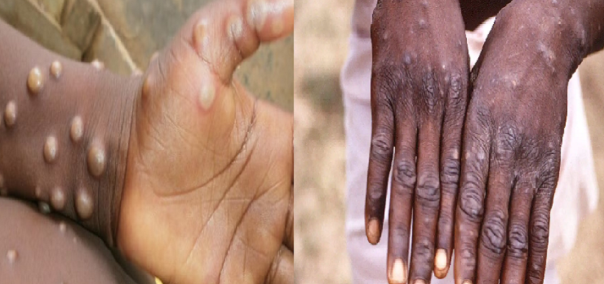 WHO ने मंकीपॉक्स को ग्लोबल हेल्थ इमरजेंसी किया घोषित, जानें इस दुर्लभ बीमारी के लक्षण और इलाज