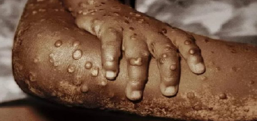 इटली के इस शख्स पर हुआ दुनिया की सभी बड़ी बीमारियों का सर्जिकल स्ट्राइक