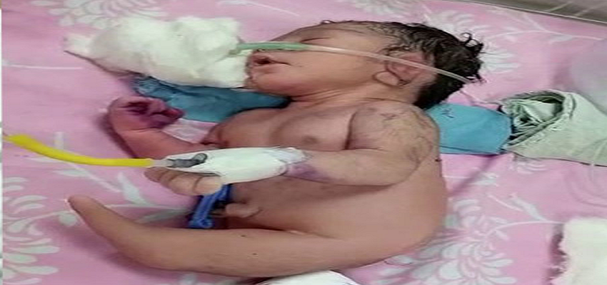 इस राज्य में दो पैरों की जगह सींग जैसे अंग के साथ पैदा हुआ बच्चा
