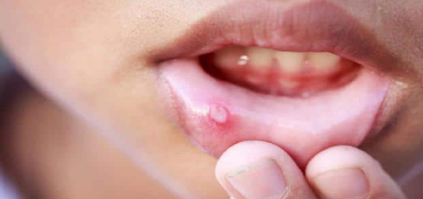 मुंह में छालों की समस्या से हो सकती है ये बीमारी, जानें कैसे करें बचाव