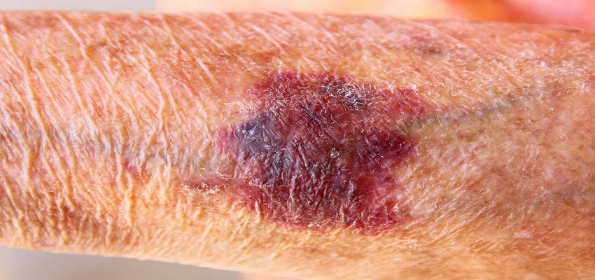 INTERNAL BLEEDING: शरीर में इंटरनल ब्लीडिंग हो सकती है खतरनाक, ये लक्षण न करें नजरअंदाज