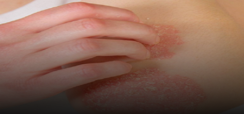 ठंड के समय बढ़ सकती है सोरायसिस की समस्या, जानें लक्षण और बचाव