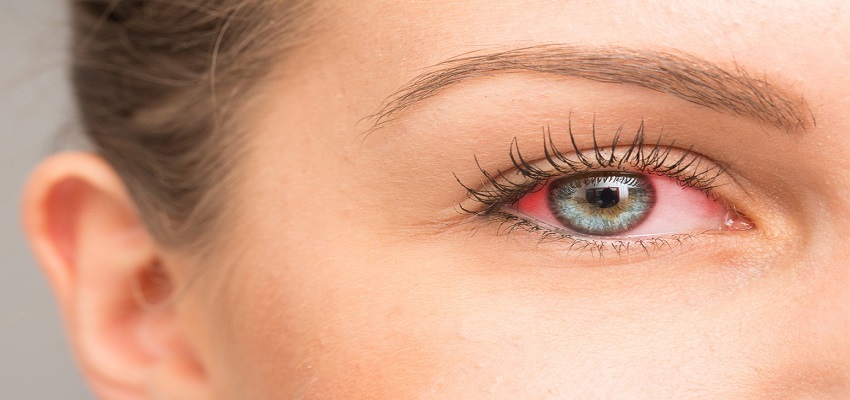 आंखों का लाल होना देता है इस गंभीर बीमारी का संकेत! जानें लक्षण और बचाव
