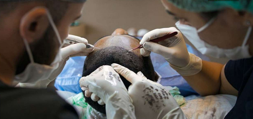 Hair transplant करवाने से जा सकती है जान! जानें क्या सच में हेयर ट्रांसप्लांट है इतना खतरनाक?