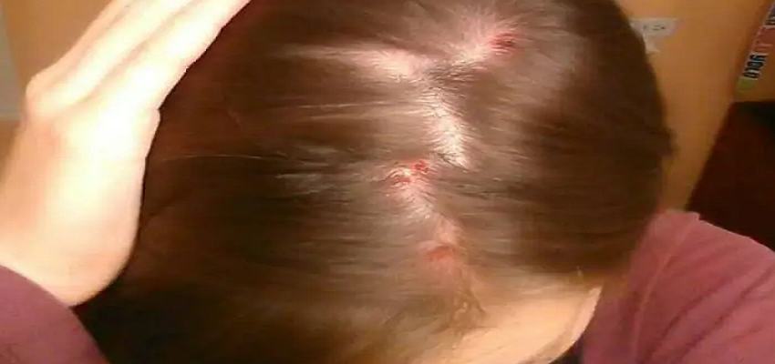 क्या आपको भी है SCALP ACNE? जानें लक्षण और बचाव