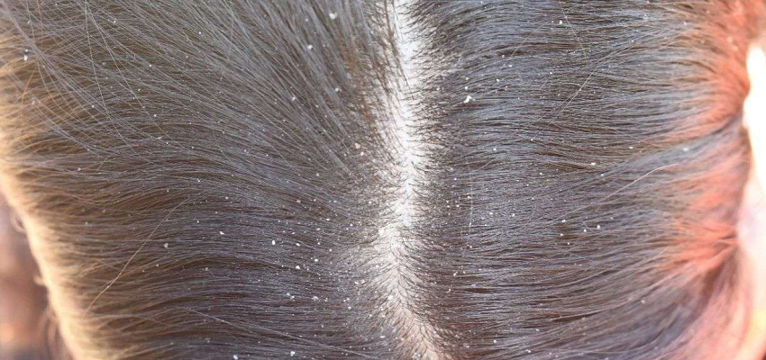Haircare In Winter: क्या सर्दियों में आप भी है डैंड्रफ से परेशान? जानें डैंड्रफ दूर करने के 5 असरदार घरेलू नुस्खे