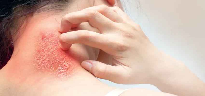 Fungal Disease : 100 में से 4 भारतीय हैं सीरियस फंगल डिजीज के मरीज, शरीर के इन अंगों को करती है प्रभावित