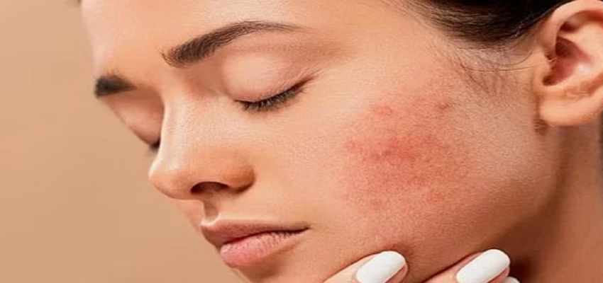 HEALTH TIP: होली खेलने से पहले इस स्किन केयर रूटीन को करें फॉलो, एलर्जी और त्वचा संबंधी समस्याएं रहेंगी दूर