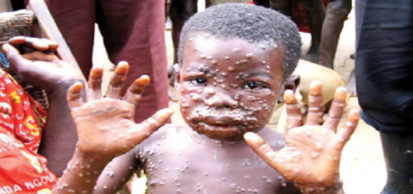 भारत के लिए खतरे की घंटी! कोरोना जैसे लक्षण वाला एक और वायरस हो सकता है सक्रिय