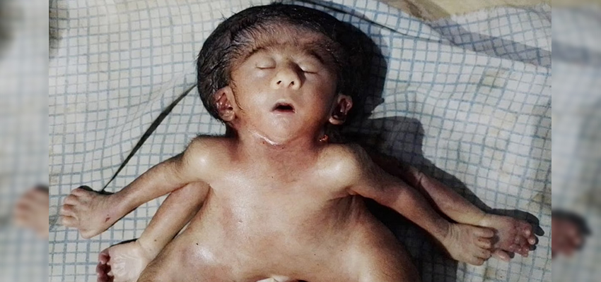 AJAB-GAJAB:  4-4 हाथ-पैर, 2 दिल और एक सिर के साथ जन्मी बच्ची, 20 मिनट में हुई मौत