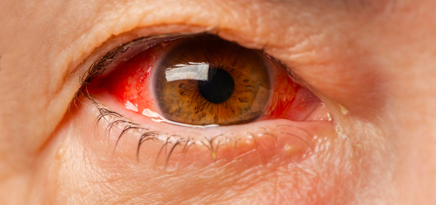 मानसून के दिनों में अपनी आंखों को रखना है स्वस्थ, तो इन आसान तरीकों को करें फॉलो