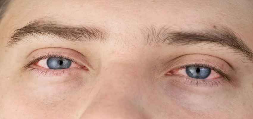 Eye Flu: महामारी के रूप 5 तरह से फैल रहा कंजंक्टिवाइटिस, ये हैं इनके लक्षण