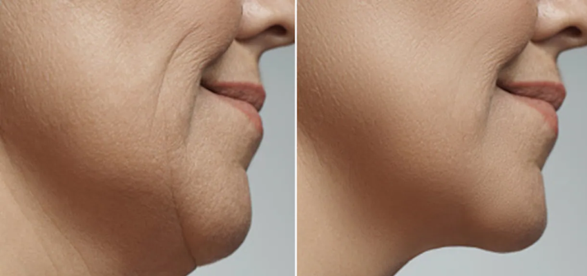 उम्र के साथ क्यों लटकने लगती चेहरे की त्वचा, जानें स्किन टाइट करने के उपाय