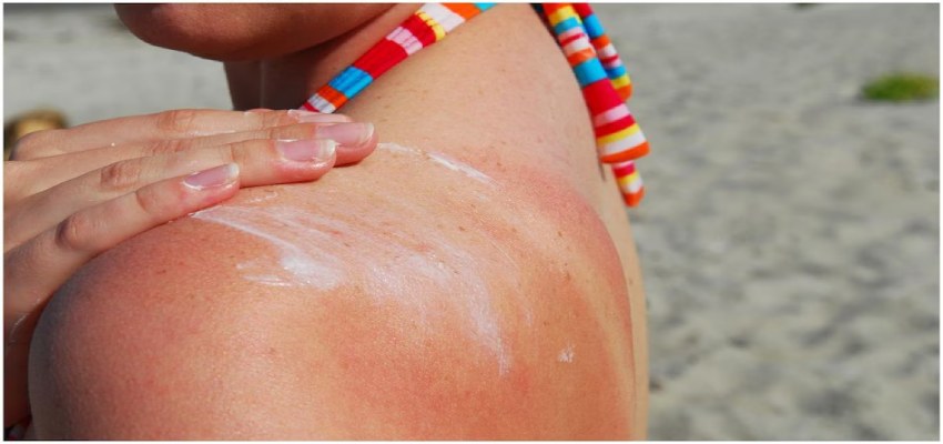 गर्मियों में Sunburn और Sun Poisoning त्वचा को पहुंचा सकते हैं गंभीर नुकसान, जानें लक्षण और बचाव के तरीके