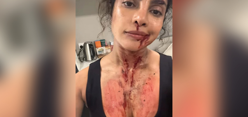 Priyanka Chopra Injured:  शूटिंग के दौरान घायल हुईं Priyanka Chopra, खून से लथपथ आईं नजर