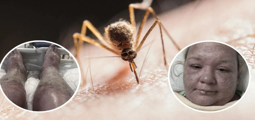 पहले मच्छर ने मारा डंक, फिर प्लास्टिक की तरह पिघल गई चमड़ी, जानें क्या है ये बीमारी