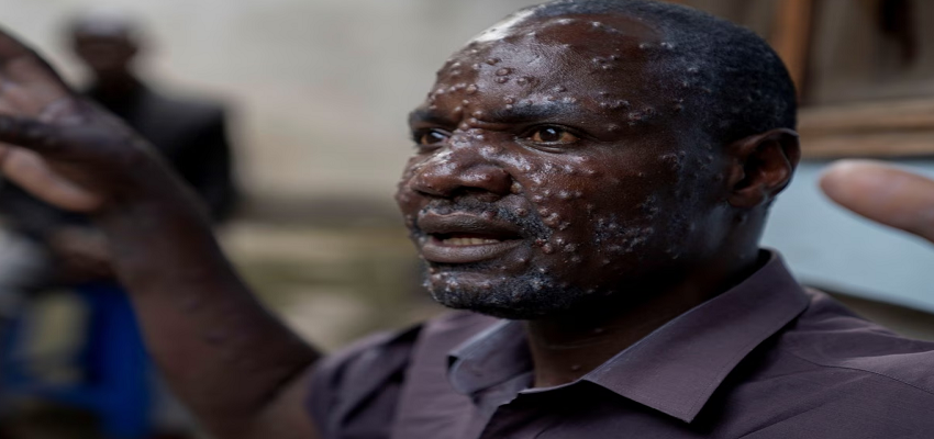 कोरोना के बाद नई महामारी ने दुनिया में मचाई खलबली, पाकिस्तान में मिला पहला केस, जानें कितना है खतरनाक