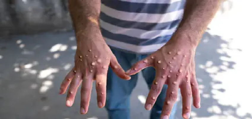 Monkeypox virus: अगर मंकीपॉक्स भारत में आया तो कितना होगा असर? जानें इंडिया के लिए कितना बड़ा खतरा