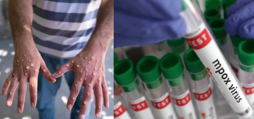 WHO ने Mpox की पहली वैक्सीन को दी मंजूरी, 82 प्रतिशत तक है प्रभावी,