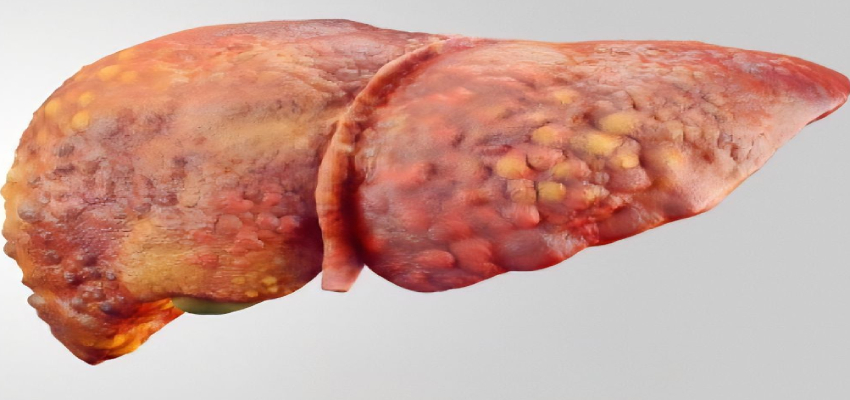 Health Tips: घर बैठे पता चलेंगे लक्षण, फैटी लीवर पहचानने के ये है 5 तरीके