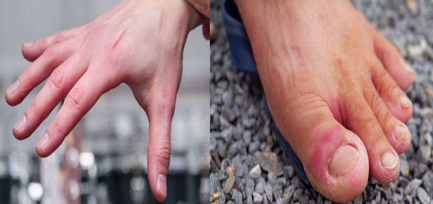 Health Tips: सर्दियों में आपके भी हाथ-पैरों की उंगलियों में होती हैं सूजन? इन टिप्स को अपनाने से मिलेगी राहत
